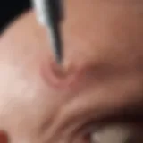 Detailed view of a biopsy needle targeting a cranial mass