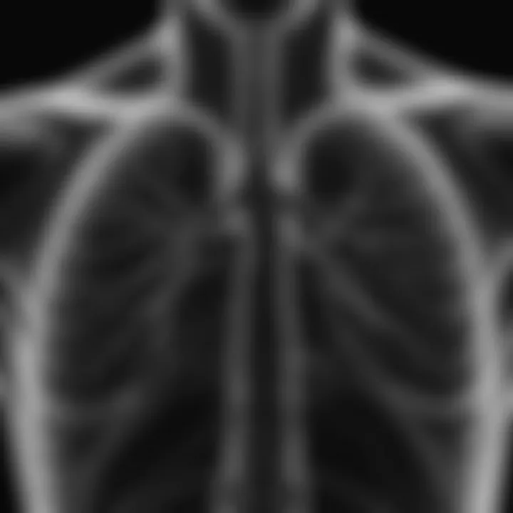 X-ray of a lung showing emphysema