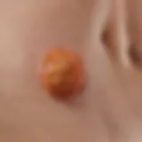 Detailed illustration of urticaria skin reaction depicting hives formation